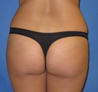 Bandingkan Sebelum & Sesudah Foto Brazilian Butt Lift