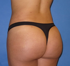 Bandingkan Sebelum & Sesudah Foto Brazilian Butt Lift