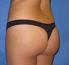 Bandingkan Sebelum & Sesudah Foto Brazilian Butt Lift