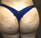 Bandingkan Sebelum & Sesudah Foto Brazilian Butt Lift