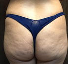 Bandingkan Sebelum & Sesudah Foto Brazilian Butt Lift