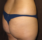 Bandingkan Sebelum & Sesudah Foto Brazilian Butt Lift