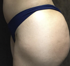 Bandingkan Sebelum & Sesudah Foto Brazilian Butt Lift