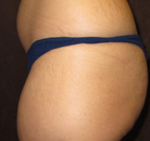 Bandingkan Sebelum & Sesudah Foto Brazilian Butt Lift