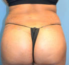 Bandingkan Sebelum & Sesudah Foto Brazilian Butt Lift