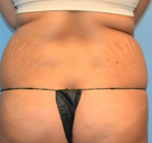 Bandingkan Sebelum & Sesudah Foto Brazilian Butt Lift