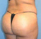 Bandingkan Sebelum & Sesudah Foto Brazilian Butt Lift