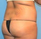 Bandingkan Sebelum & Sesudah Foto Brazilian Butt Lift