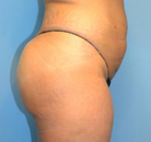 Bandingkan Sebelum & Sesudah Foto Brazilian Butt Lift