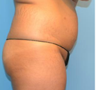 Bandingkan Sebelum & Sesudah Foto Brazilian Butt Lift