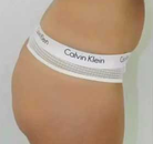 So sánh Ảnh Trước và Sau của Nâng mông