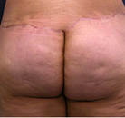 So sánh Ảnh Trước và Sau của Nâng mông