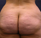 So sánh Ảnh Trước và Sau của Nâng mông