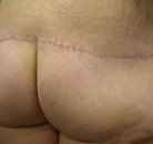 So sánh Ảnh Trước và Sau của Nâng mông