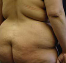 So sánh Ảnh Trước và Sau của Nâng mông