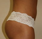 So sánh Ảnh Trước và Sau của Nâng mông