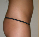 So sánh Ảnh Trước và Sau của Nâng mông