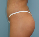 So sánh Ảnh Trước và Sau của Nâng mông