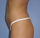 So sánh Ảnh Trước và Sau của Nâng mông