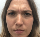  Bandingkan Sebelum & Sesudah Foto Perawatan Keriput