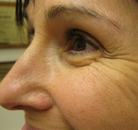  Bandingkan Sebelum & Sesudah Foto Perawatan Keriput