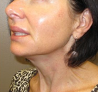  Bandingkan Sebelum & Sesudah Foto Perawatan Keriput