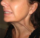  Bandingkan Sebelum & Sesudah Foto Perawatan Keriput