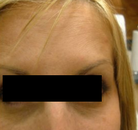  Bandingkan Sebelum & Sesudah Foto Perawatan Keriput