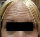  Bandingkan Sebelum & Sesudah Foto Perawatan Keriput