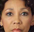  Bandingkan Sebelum & Sesudah Foto Perawatan Keriput