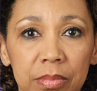  Bandingkan Sebelum & Sesudah Foto Perawatan Keriput