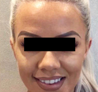  Bandingkan Sebelum & Sesudah Foto Suntik Botox