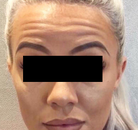  Bandingkan Sebelum & Sesudah Foto Suntik Botox