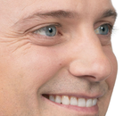  Bandingkan Sebelum & Sesudah Foto Suntik Botox