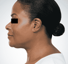  Bandingkan Sebelum & Sesudah Foto Suntik Botox