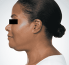  Bandingkan Sebelum & Sesudah Foto Suntik Botox