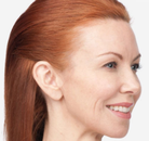  Bandingkan Sebelum & Sesudah Foto Suntik Botox