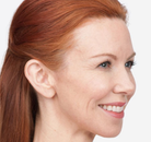  Bandingkan Sebelum & Sesudah Foto Suntik Botox