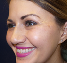  Bandingkan Sebelum & Sesudah Foto Suntik Botox