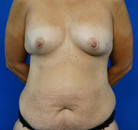  Bandingkan Sebelum & Sesudah Foto Mommy Makeover