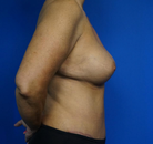  Bandingkan Sebelum & Sesudah Foto Mommy Makeover