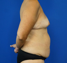  Bandingkan Sebelum & Sesudah Foto Mommy Makeover