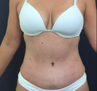  Bandingkan Sebelum & Sesudah Foto Mommy Makeover