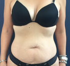  Bandingkan Sebelum & Sesudah Foto Mommy Makeover