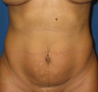  Bandingkan Sebelum & Sesudah Foto Mommy Makeover