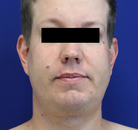  Bandingkan Sebelum & Sesudah Foto Neck Lift