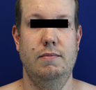  Bandingkan Sebelum & Sesudah Foto Neck Lift