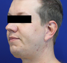  Bandingkan Sebelum & Sesudah Foto Neck Lift