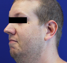  Bandingkan Sebelum & Sesudah Foto Neck Lift