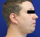  Bandingkan Sebelum & Sesudah Foto Neck Lift